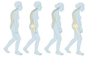 Osteoporosis Diseases That Can Be Prevented By Healthy Diet Nutrition and Wellness Services of Beyond Mirror